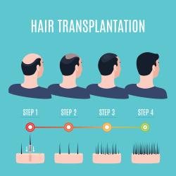 ปลูกผมและคิ้วด้วย FUE ( Follicular Unit Extraction )  Hair Transplantation by FUE