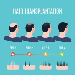 ปลูกผมและคิ้วด้วย FUE ( Follicular Unit Extraction )  Hair Transplantation by FUE